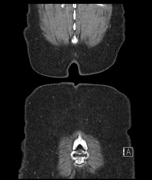 Calcified adrenal glands and Spigelian hernia (Radiopaedia 49741-54988 B 115).jpg