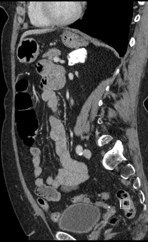 Calcified adrenal glands and Spigelian hernia (Radiopaedia 49741-54988 C 65).jpg