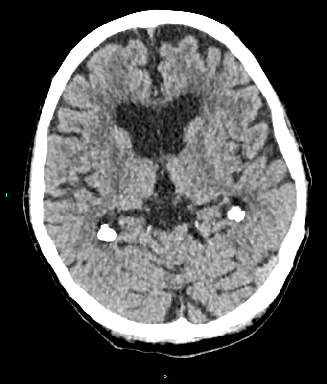 Calcified cerebral emboli from left ventricular thrombus (Radiopaedia 84420-99758 Axial non-contrast 51).jpg