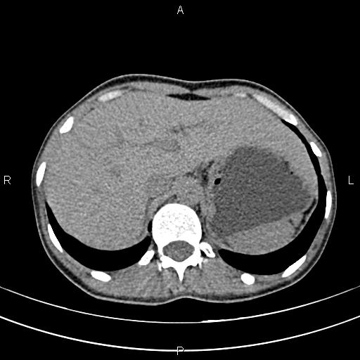 File:Calcified hepatic hydatid cyst (Radiopaedia 83870-99072 Axial non-contrast 36).jpg