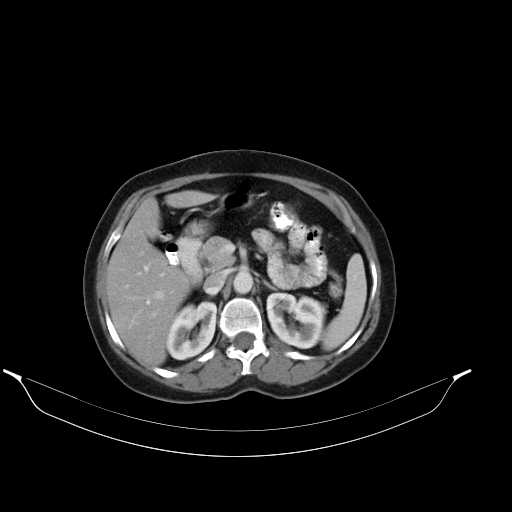 File:Calcified hydatid cyst of the liver (Radiopaedia 21212-21112 A 13).jpg