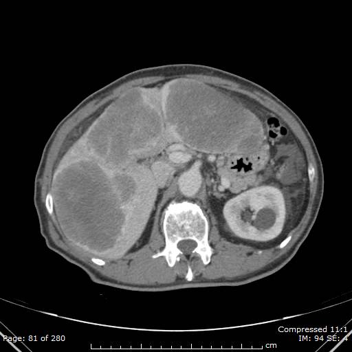 Calcified liver metastases (Radiopaedia 44699-48470 B 29).jpg