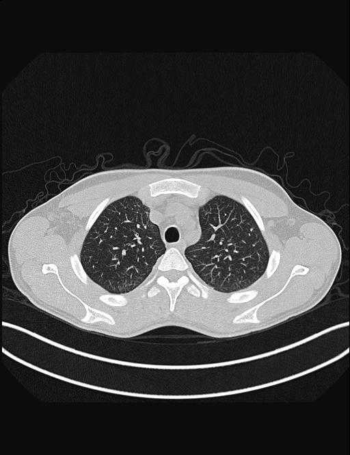 Calcifying pulmonary metastases (Radiopaedia 33359-34396 Axial lung window 15).jpg