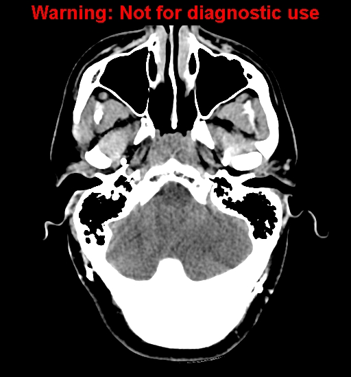 File:Calvarial thickening from chronic shunting (Radiopaedia 60079-67637 Axial non-contrast 5).jpg