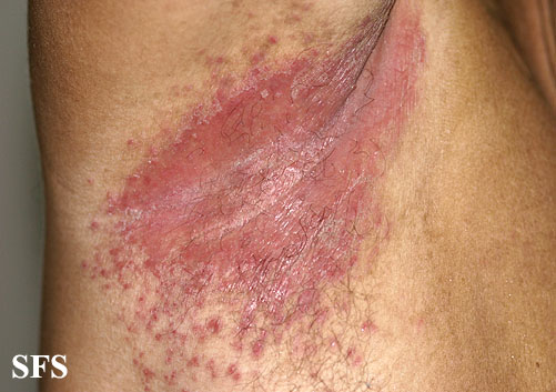 File:Candidiasis (Dermatology Atlas 22).jpg