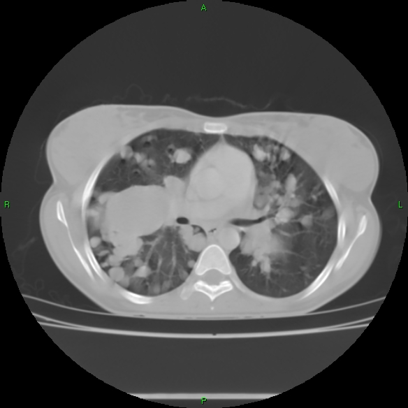 File:Cannon ball metastases - synovial sarcoma (Radiopaedia 26135-26271 Axial lung window 17).jpg