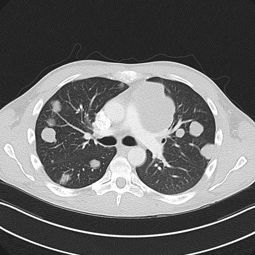Cannonball metastases - testicular choriocarcinoma (Radiopaedia 84510-99891 Axial lung window 42).jpg
