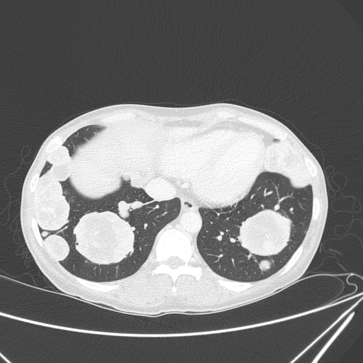 File:Canonball lung metastasis (Radiopaedia 77634-89837 Axial lung window 140).jpg