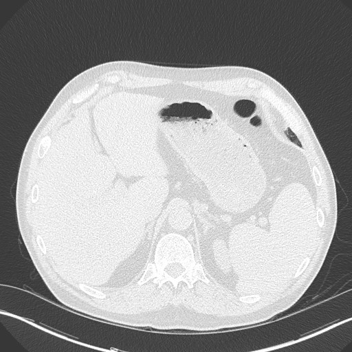 Caplan syndrome (Radiopaedia 56667-63530 Axial lung window 184).jpg