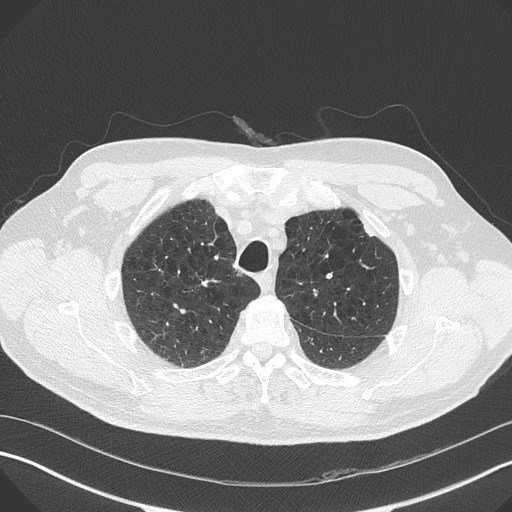 Caplan syndrome (Radiopaedia 56667-63530 Axial lung window 48).jpg