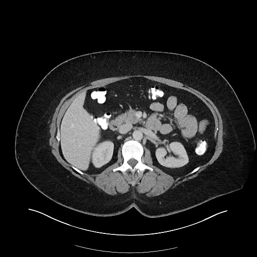 Carcinoid tumor - terminal ileum (Radiopaedia 60931-68739 A 50).jpg