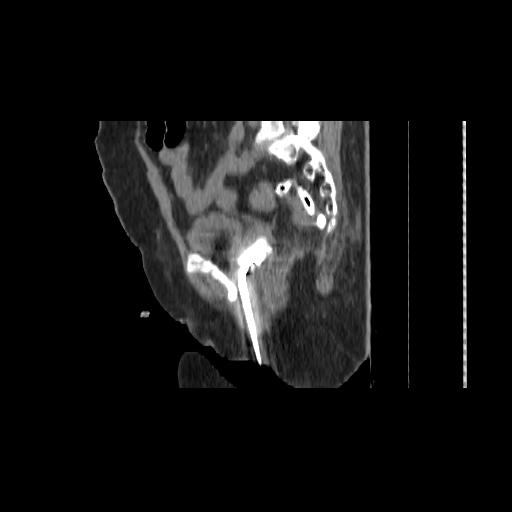 File:Carcinoma cervix- brachytherapy applicator (Radiopaedia 33135-34173 D 111).jpg