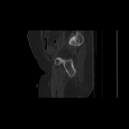 File:Carcinoma cervix- brachytherapy applicator (Radiopaedia 33135-34173 Sagittal bone window 31).jpg