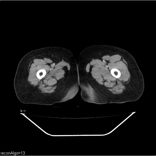 File:Carcinoma cervix- recurrence (Radiopaedia 34702-36137 B 62).jpg