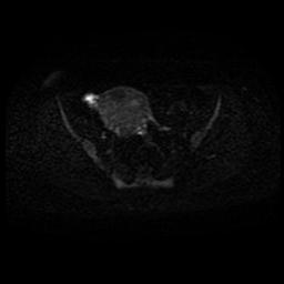 Carcinoma of the cervix (Radiopaedia 89018-105858 Axial DWI 38).jpg
