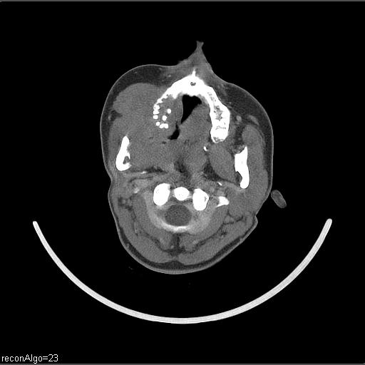 Carcinoma of the maxillary antrum (Radiopaedia 53805-59888 Axial C+ delayed 45).jpg