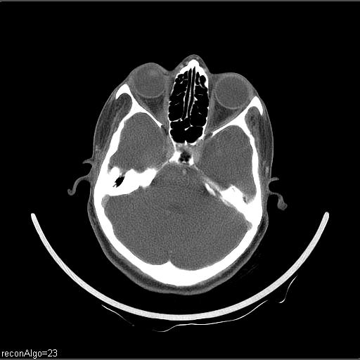Carcinoma of the maxillary antrum (Radiopaedia 53805-59888 Axial C+ delayed 65).jpg