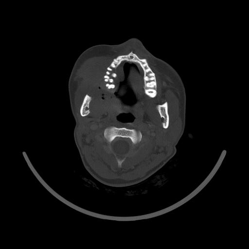 Carcinoma of the maxillary antrum (Radiopaedia 53805-59888 Axial bone window 77).jpg