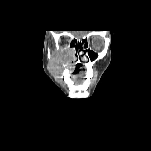 Carcinoma of the maxillary antrum (Radiopaedia 53805-59888 Coronal C+ delayed 32).jpg