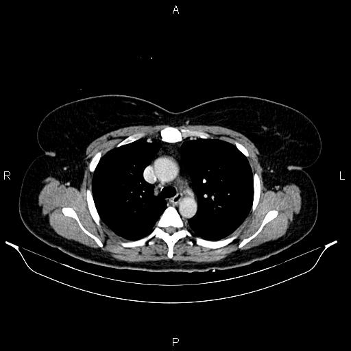 Carcinoma of uterine cervix (Radiopaedia 85861-101700 A 15).jpg