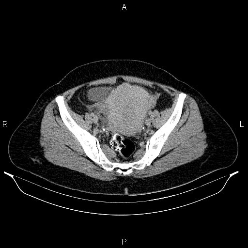 File:Carcinoma of uterine cervix (Radiopaedia 85861-101700 Axial C+ delayed 72).jpg