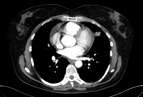 Cardiac sarcoidosis (Radiopaedia 74548-85534 A 47).jpg