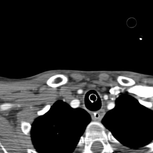 Carotid arterial dissection (Radiopaedia 30001-30548 B 23).jpg
