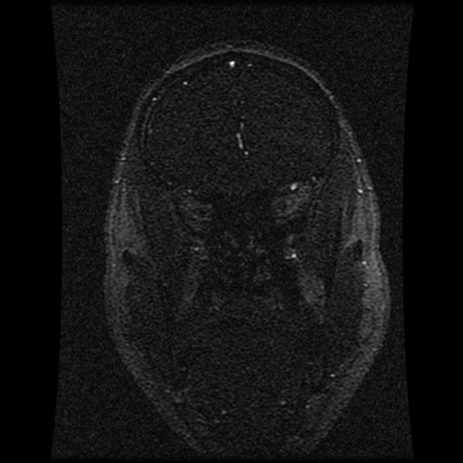 Carotid arterial dissection with acute cerebral infarction (Radiopaedia 26636-26784 MRV 124).jpg