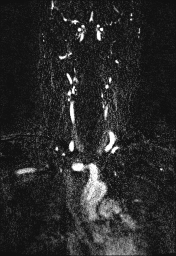 Carotid artery dissection (Radiopaedia 28441-28689 Coronal MRA 30).jpg