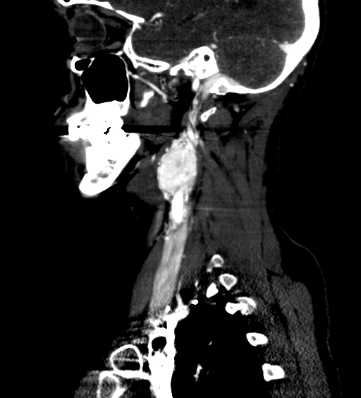 File:Carotid body tumor (Radiopaedia 39845-42300 D 29).jpg