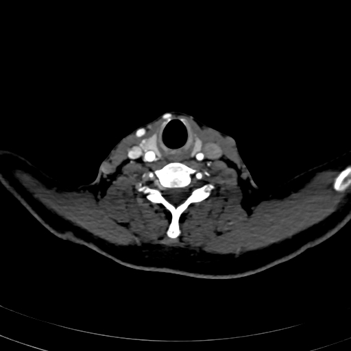 File:Carotid body tumor (Radiopaedia 83615-98727 A 86).jpg