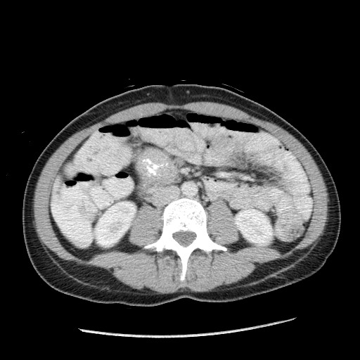 Castleman disease with fibrous pseudotumor in the abdomen (Radiopaedia 77296-89373 A 66).jpg