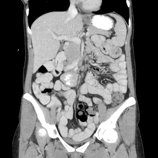 Castleman disease with fibrous pseudotumor in the abdomen (Radiopaedia 77296-89373 B 41).jpg