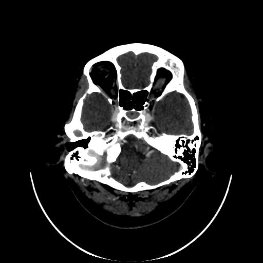 Cavernoma with developmental venous anomaly (Radiopaedia 22470-22506 C 20).jpg