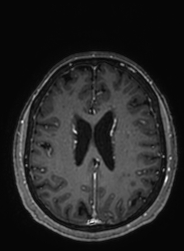 Cavernous hemangioma of the cerebellar falx (Radiopaedia 73025-83724 Axial T1 C+ 117).jpg