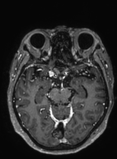 Cavernous hemangioma of the cerebellar falx (Radiopaedia 73025-83724 Axial T1 C+ 205).jpg