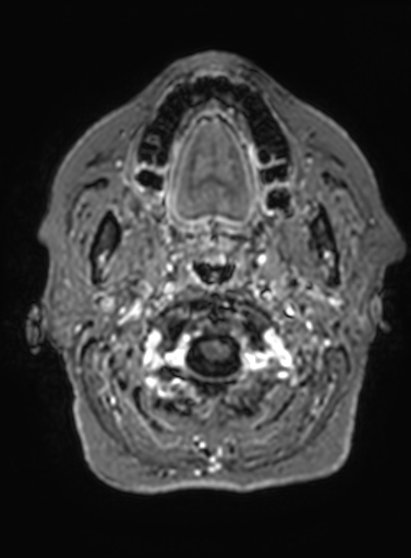 File:Cavernous hemangioma of the cerebellar falx (Radiopaedia 73025-83724 Axial T1 C+ 337).jpg