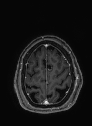 Cavernous hemangioma of the cerebellar falx (Radiopaedia 73025-83724 Axial T1 C+ 57).jpg