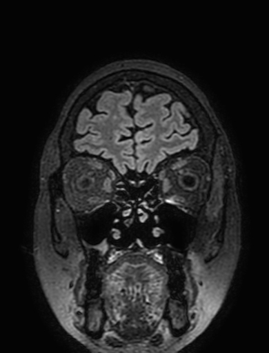 Cavernous hemangioma of the cerebellar falx (Radiopaedia 73025-83724 Coronal FLAIR 48).jpg