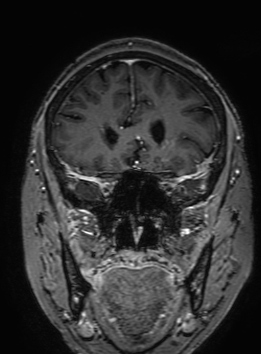 Cavernous hemangioma of the cerebellar falx (Radiopaedia 73025-83724 Coronal T1 C+ 115).jpg