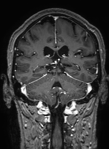 Cavernous hemangioma of the cerebellar falx (Radiopaedia 73025-83724 Coronal T1 C+ 240).jpg