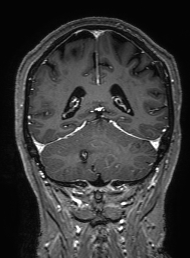 Cavernous hemangioma of the cerebellar falx (Radiopaedia 73025-83724 Coronal T1 C+ 265).jpg