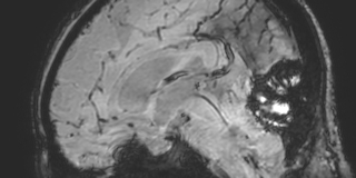 Cavernous hemangioma of the cerebellar falx (Radiopaedia 73025-83724 Sagittal BOLD 104).jpg