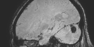 File:Cavernous hemangioma of the cerebellar falx (Radiopaedia 73025-83724 Sagittal BOLD 141).jpg