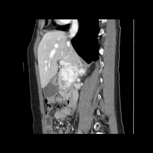 Cavernous hepatic hemangioma (Radiopaedia 75441-86667 D 77).jpg