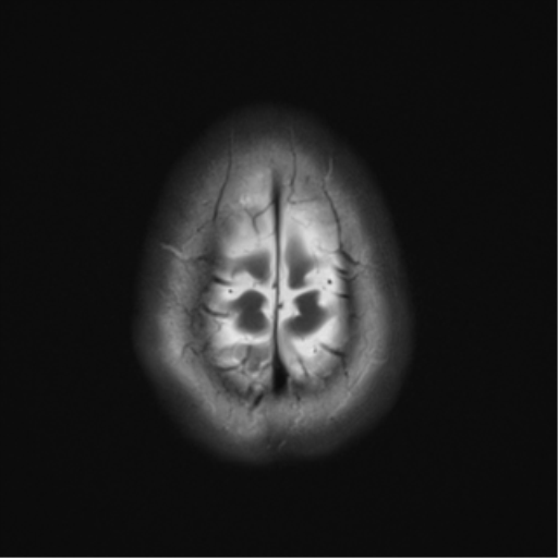 File:Cavernous malformation (cavernous angioma or cavernoma) (Radiopaedia 36675-38237 Axial T2 21).png
