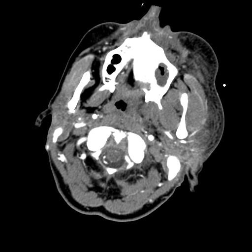File:Cavernous sinus thrombosis (Radiopaedia 10619-11078 A 10).jpg