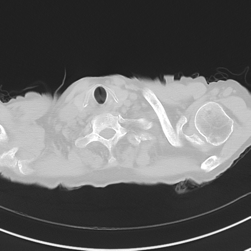 Cavitating pneumonia - lingular segments (Radiopaedia 34386-35678 Axial lung window 3).png