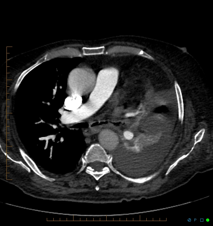 Cavitating pulmonary infarction (Radiopaedia 54634-60849 Axial C+ CTPA 34).jpg