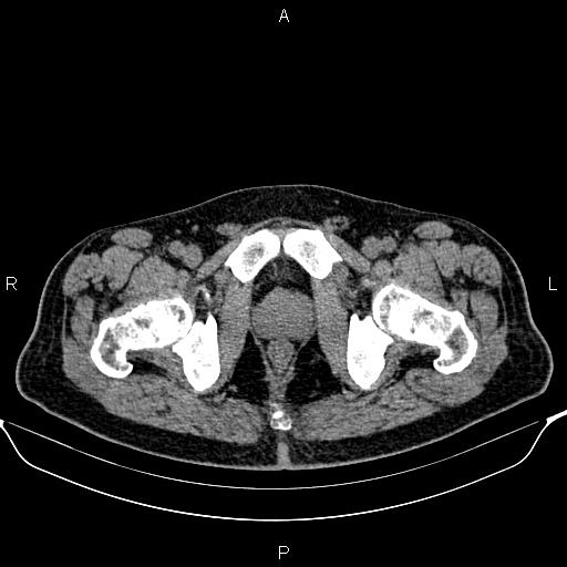 Cecal adenocarcinoma (Radiopaedia 85324-100916 Axial non-contrast 100).jpg